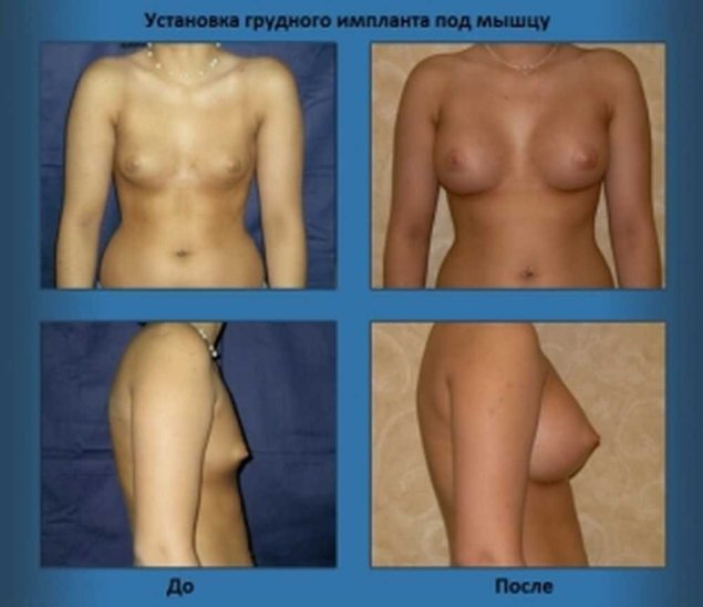 Импланты грудные