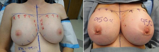 Огромные сиськи с имплантами