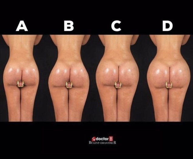 Операция по увеличению ягодиц