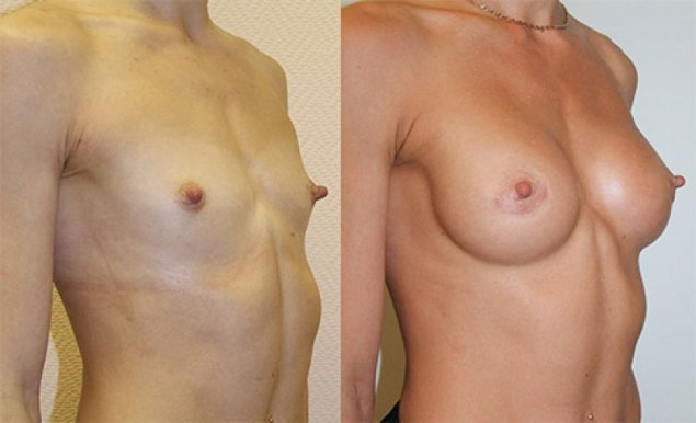 Анатомические импланты