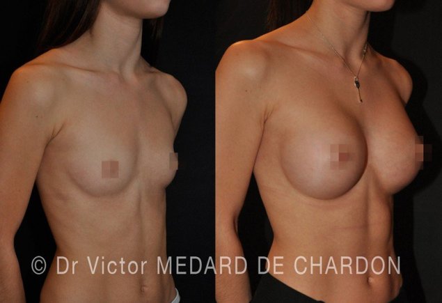 Силиконовая грудь круглая и анатомическая