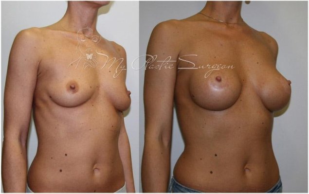 Грудь круглая после операции