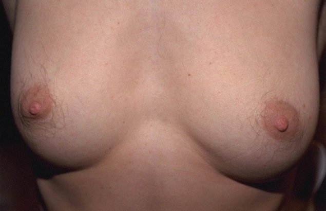 Пролактиновая гинекомастия