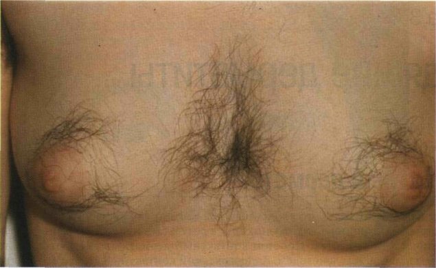 Волосы на женских сосках