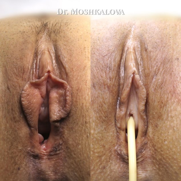 Пластика больших половых губ