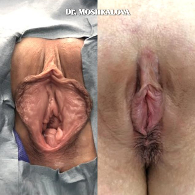 Вагина барби лабиопластика