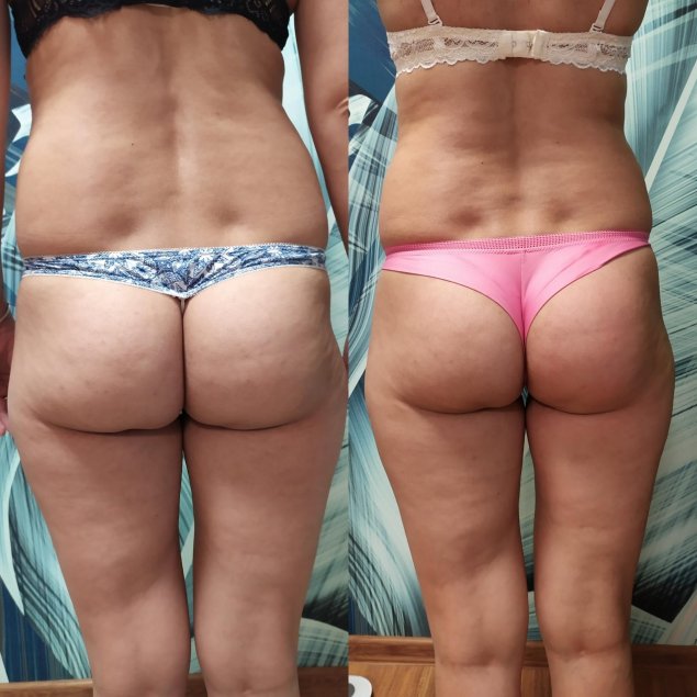 Антицеллюлитный массаж до и после 10 сеансов