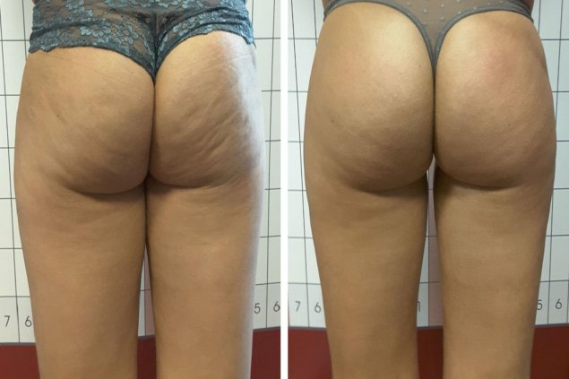 До и после антицеллюлитного массажа