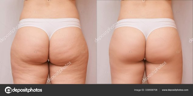 Липодистрофия целлюлит