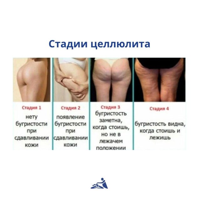 Целлюлит стадии