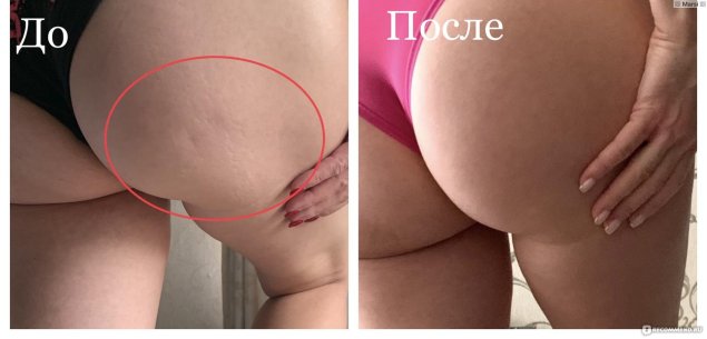 Целлюлит и растяжки