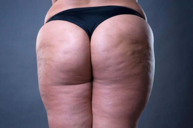 Липодистрофия целлюлит