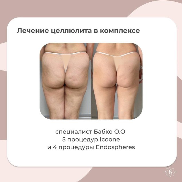 Лечение целлюлита