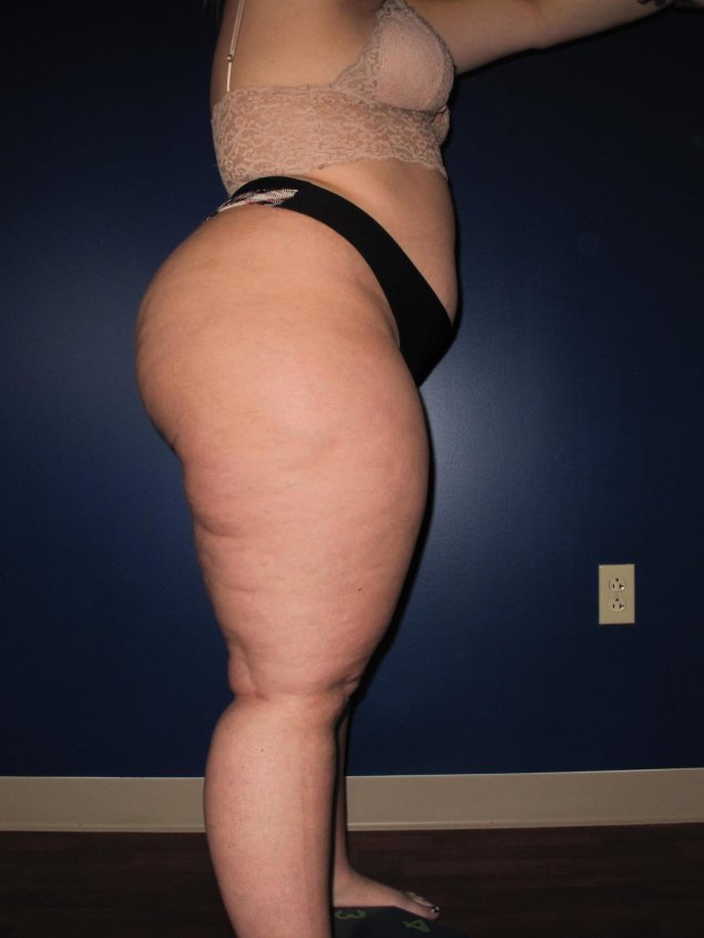 Жирные целлюлитные женщины