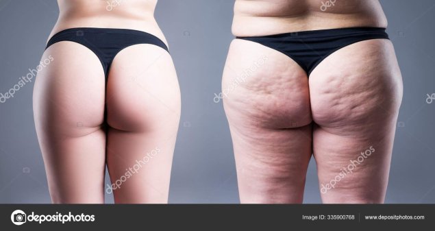 Целлюлит на ногах