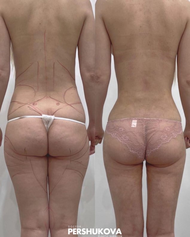Липосакция бедер и ягодиц
