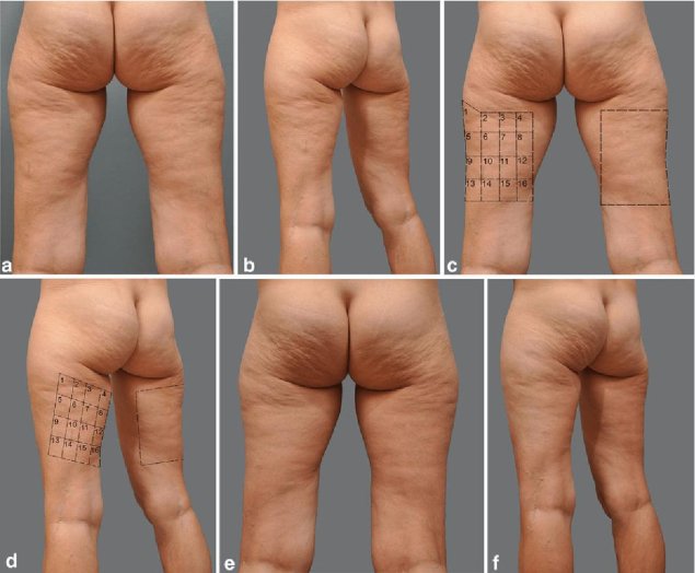 Липодистрофия целлюлит