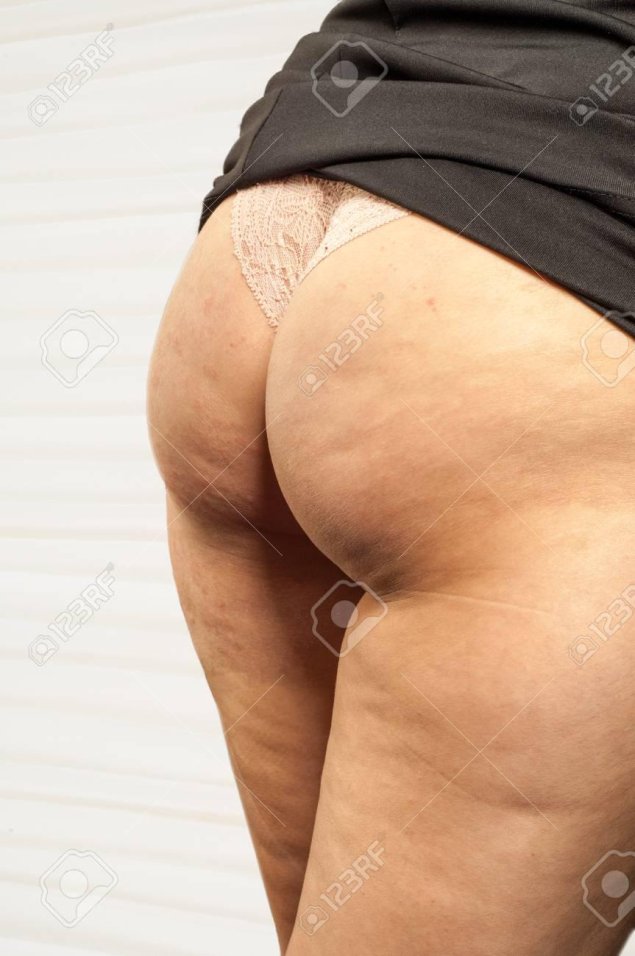 Липодистрофия целлюлит