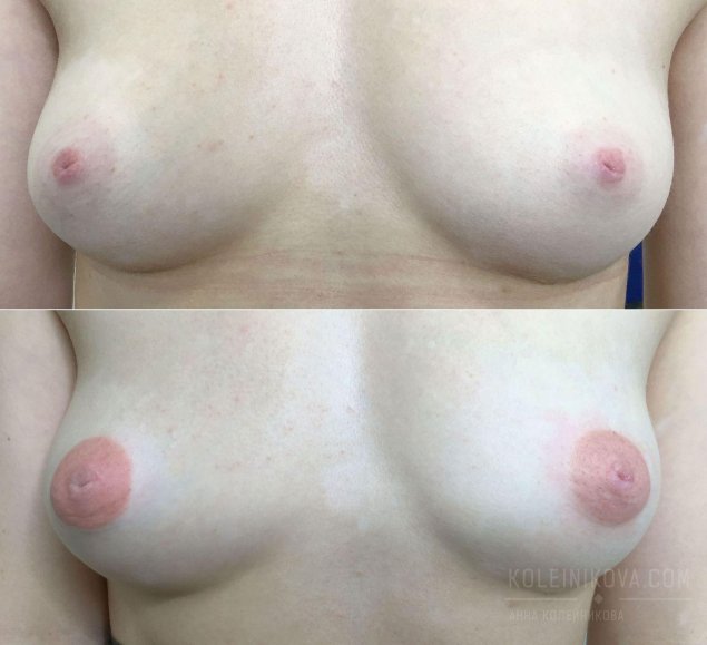 Женская грудь без ореолов