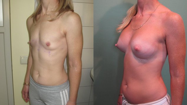 Нулевка грудь