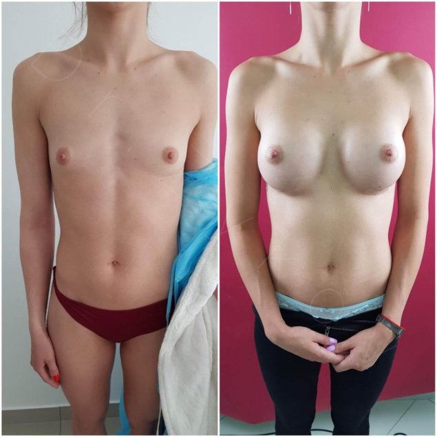 Увеличенная женская грудь