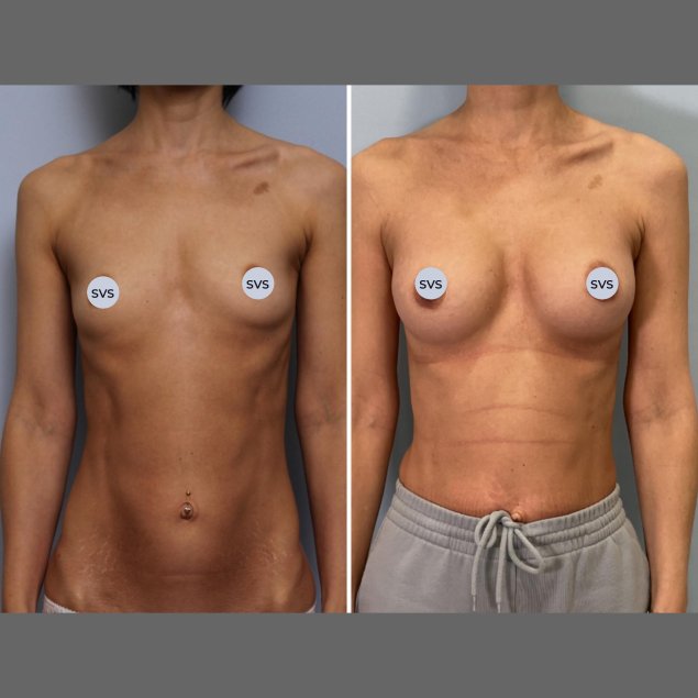 Анатомический имплант груди