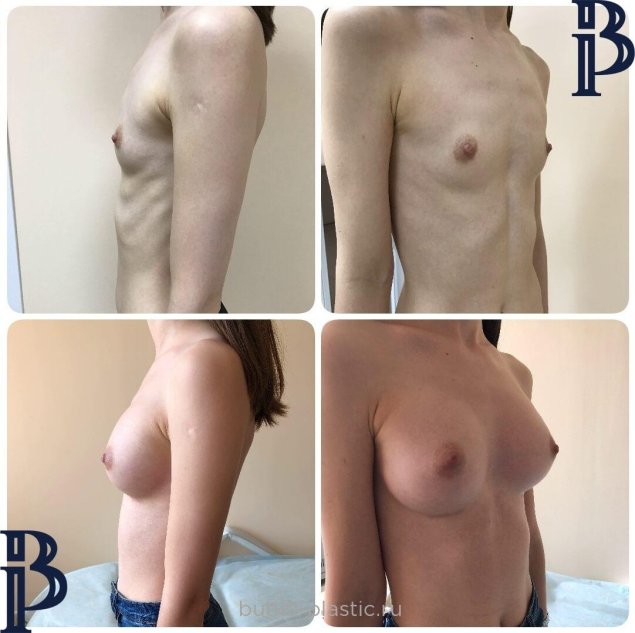 До и после увеличения груди