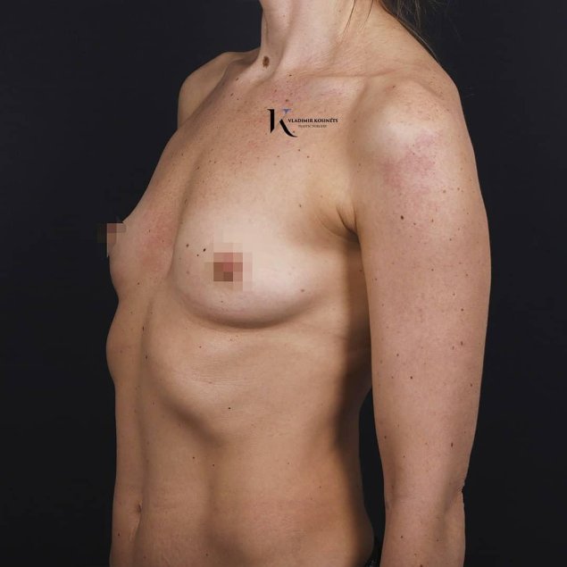 До и после увеличения груди