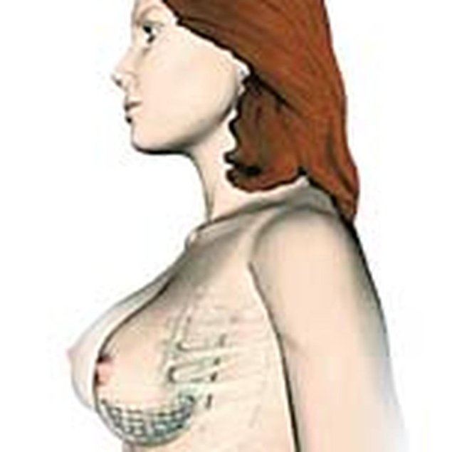 Периареолярная мастопексия