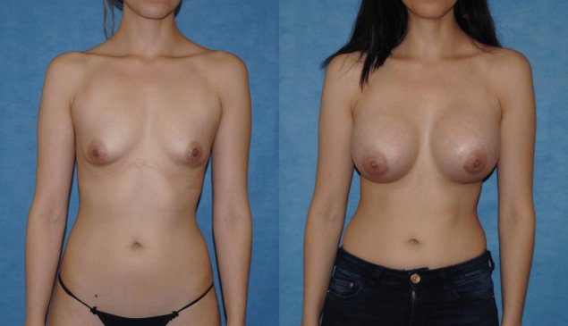 Увеличенная грудь