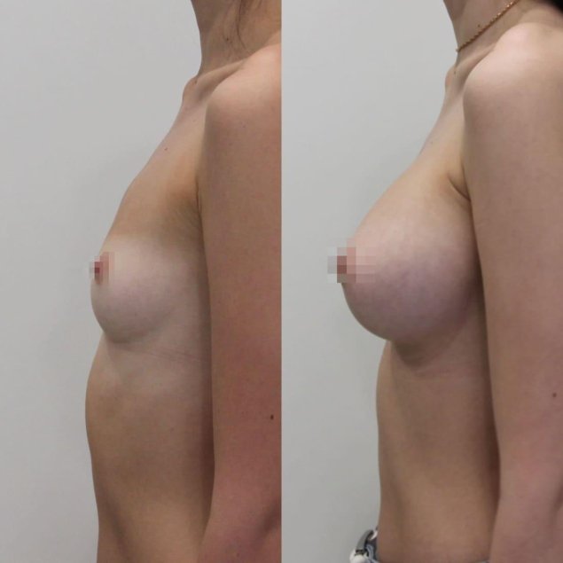 Порноактрисы увеличившая.грудь