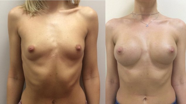 До и после увеличения груди