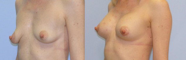 Увеличение молочных желез