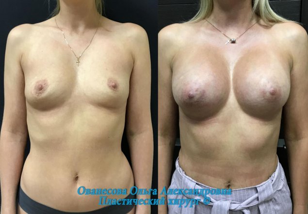 Грудь до и после увеличения