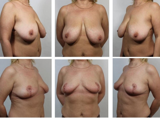 Обвисает грудь