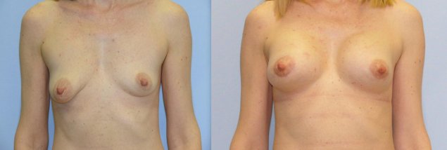 Гинекомастия липосакция