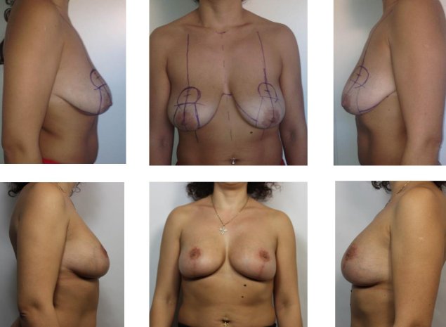 Операция по увеличению груди