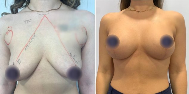 Пластическая операция груди