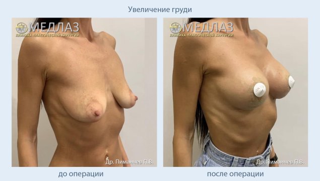 Увеличение груди в москве