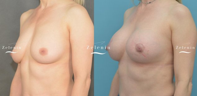 Голая грудь после подтяжки