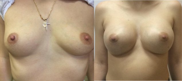 Маммопластика операция