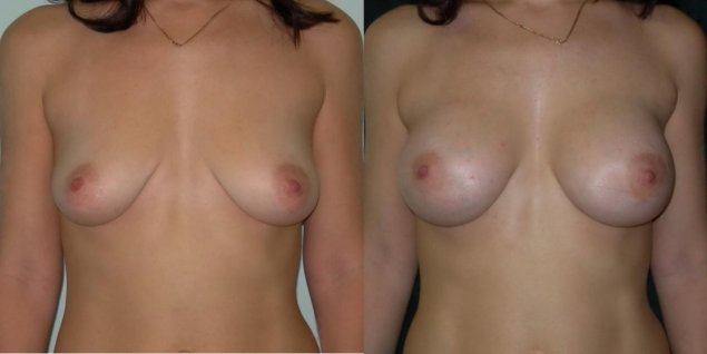 Грудь увеличение