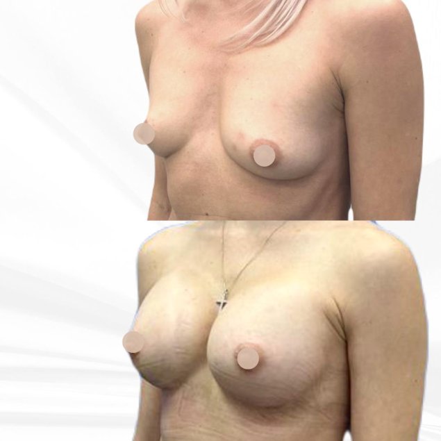 Коррекция груди без имплантов