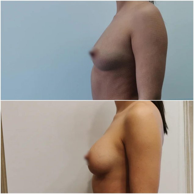 Увеличение груди