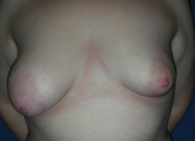 Ассиметричная грудь