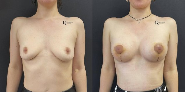 Подтяжка груди шрамы