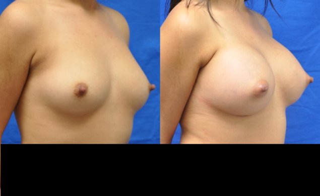 Breast augmentation