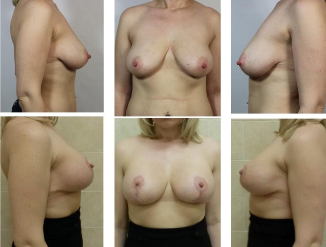 Каплевидное увеличение груди