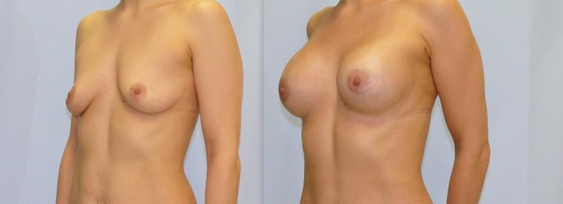 Увеличение грудных желез