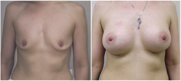 Имплант груди